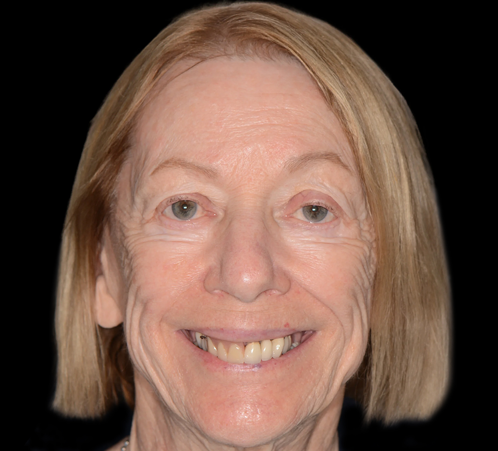 Before and after photos of the All-On-4 surgery with Lux Smile