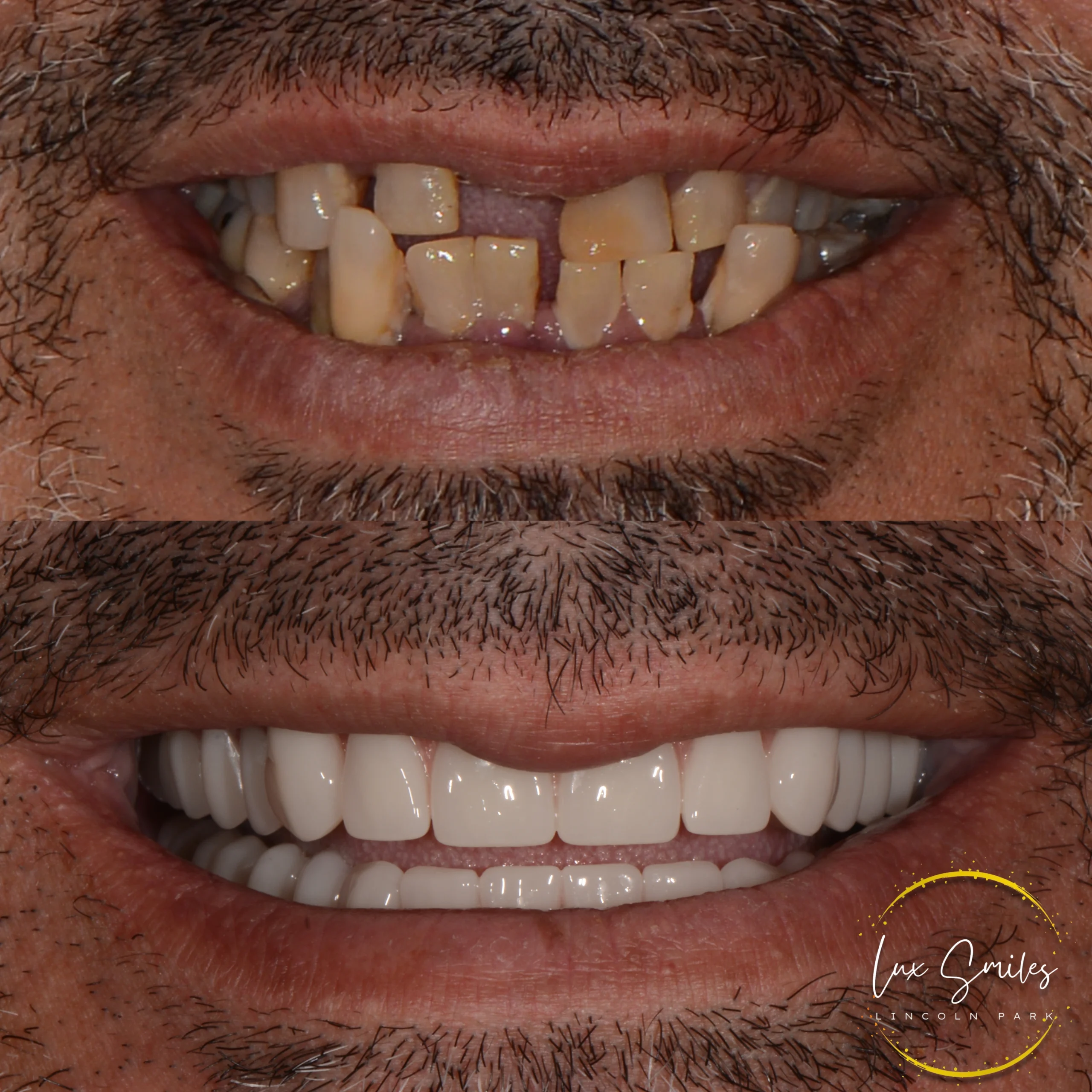 before & after all-on-implant treatment Chicago IL