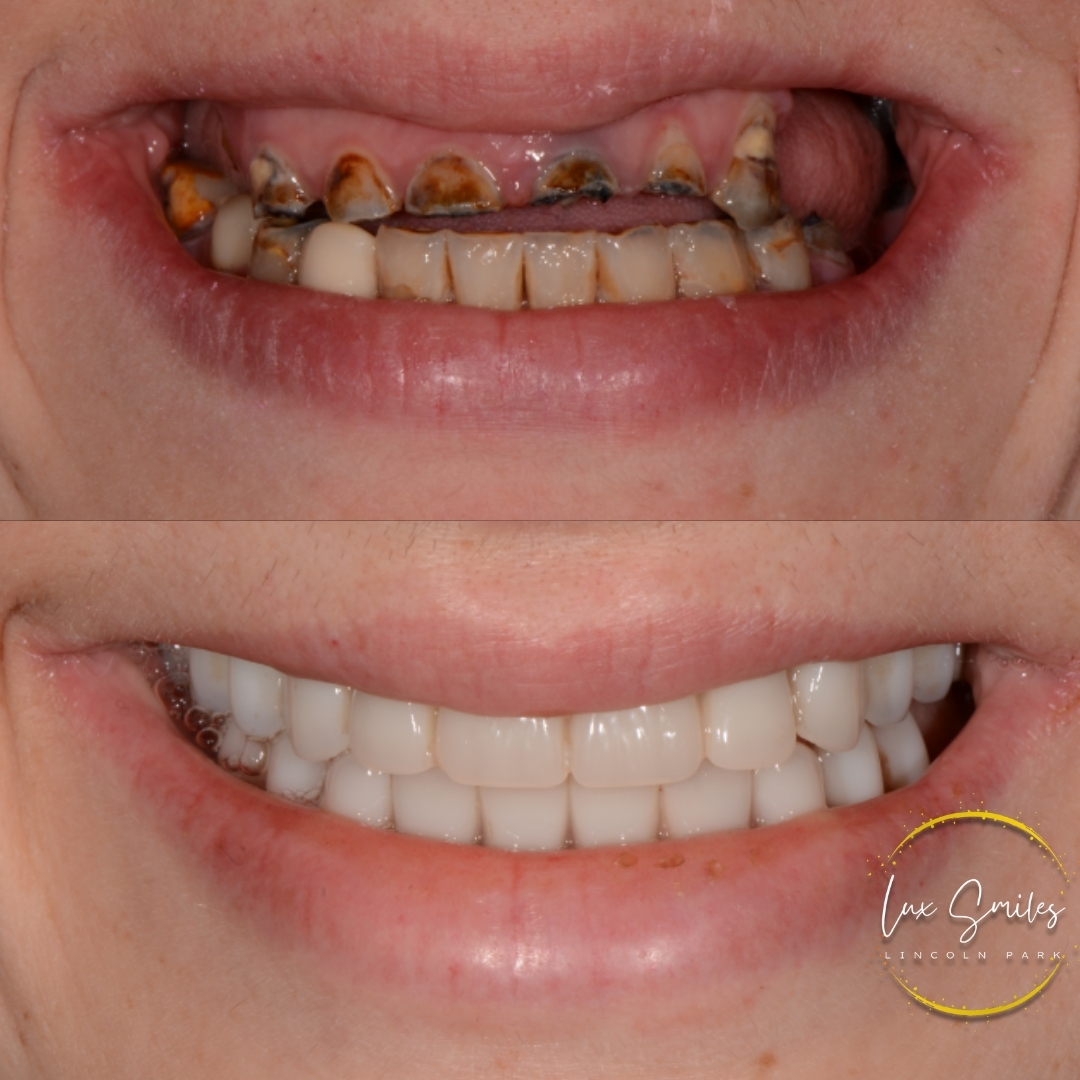 before and after damage tooth treatment Chicago IL