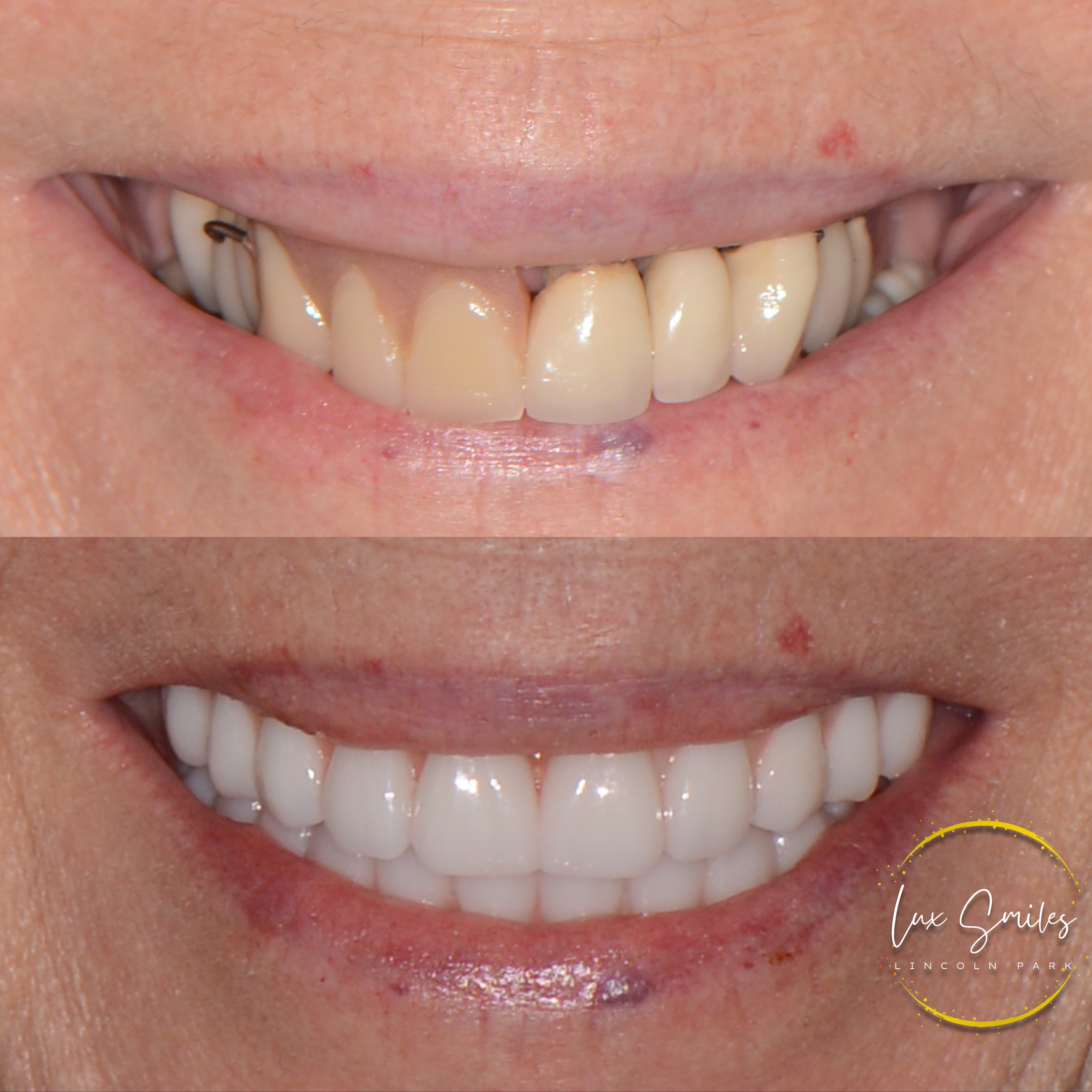 bfore and after teeth whitening procedure Chicago IL