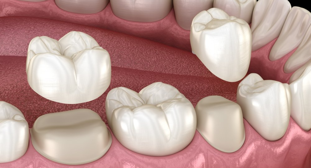 porcelain crowns for front teeth restoration in chicago