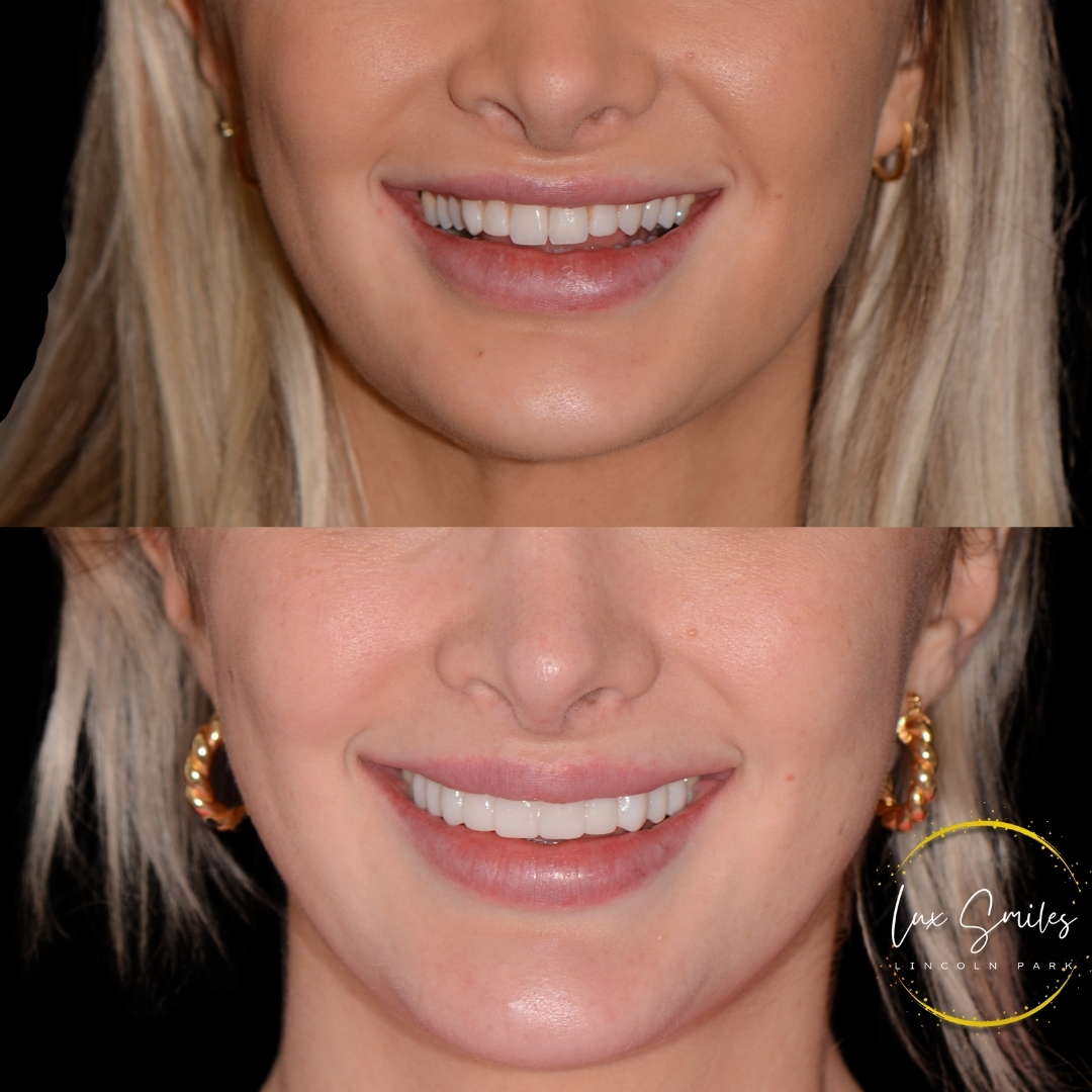 Before and after teeth whitening treatment Chicago IL
