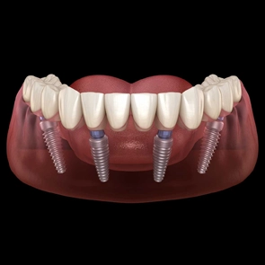 All-on-4 dental implants at Lux Smiles