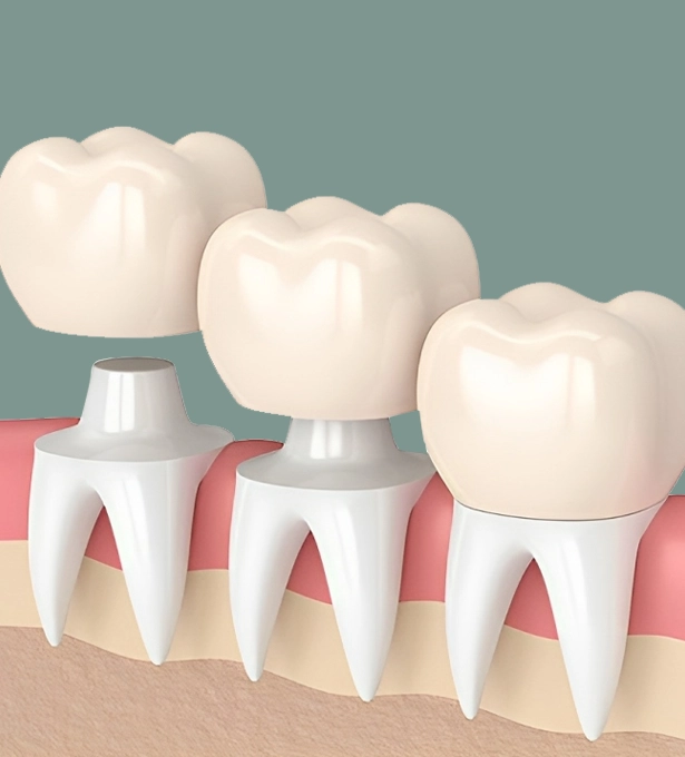lux smiles provide top-quality dental crowns at chicago il