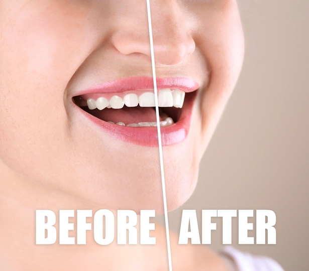 Before and after gum contouring at Lux Smiles.