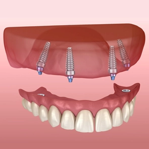 implant retained dentures Chicago IL