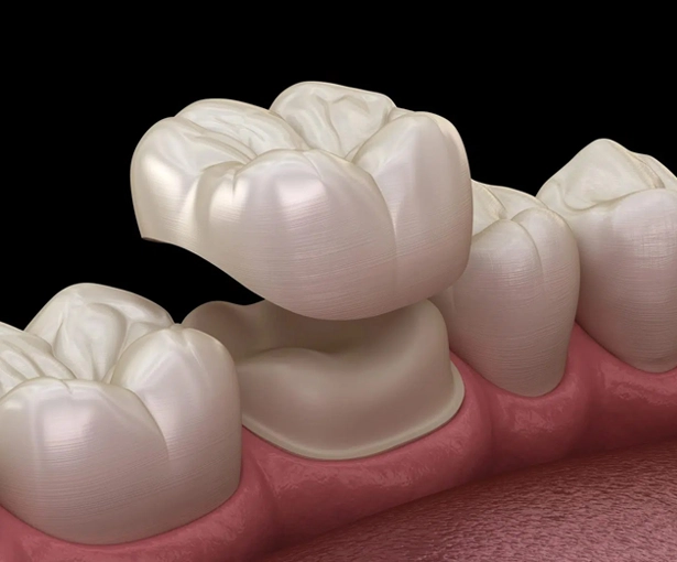 Porcelain crowns Chicago IL