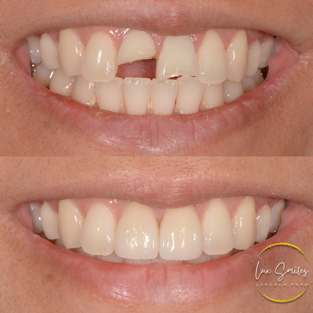 before and after chipped tooth treatment Chicago IL