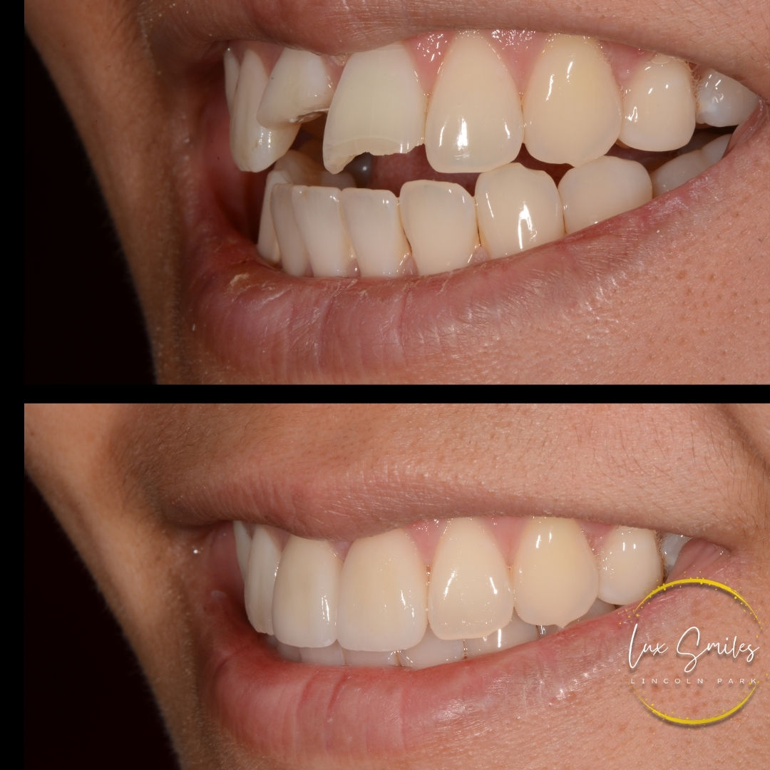 before and after broken tooth treatment Chicago IL