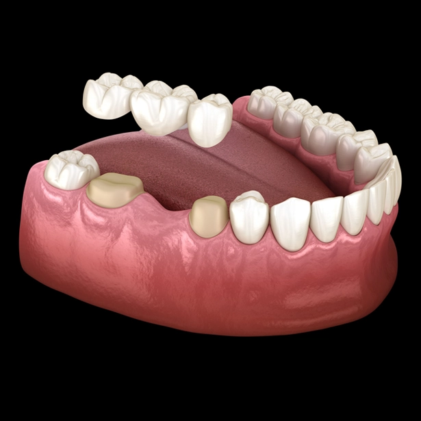 Custom Dental Bridges Chicago IL