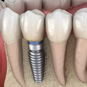 single dental Implant Chicago