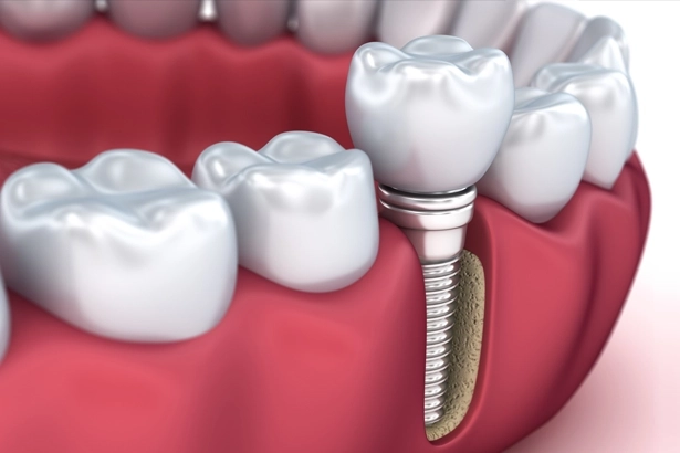 single tooth implants  bridges Chicago IL