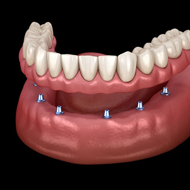 Comfortable Snap-In Implant Dentures in Chicago il