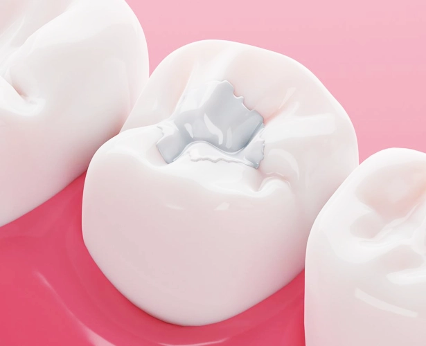 Flawless smile in Chicago il with tooth-colored fillings