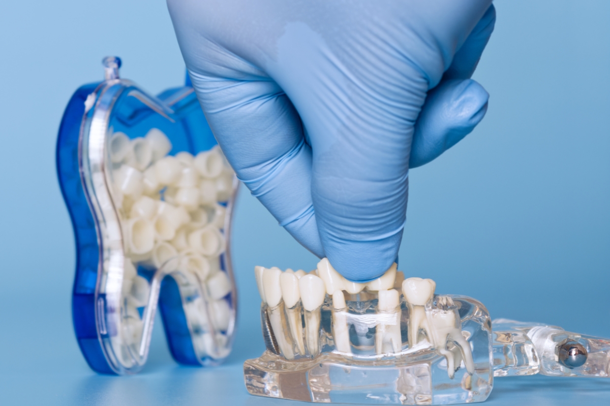 dental-bridges-in-Chicago