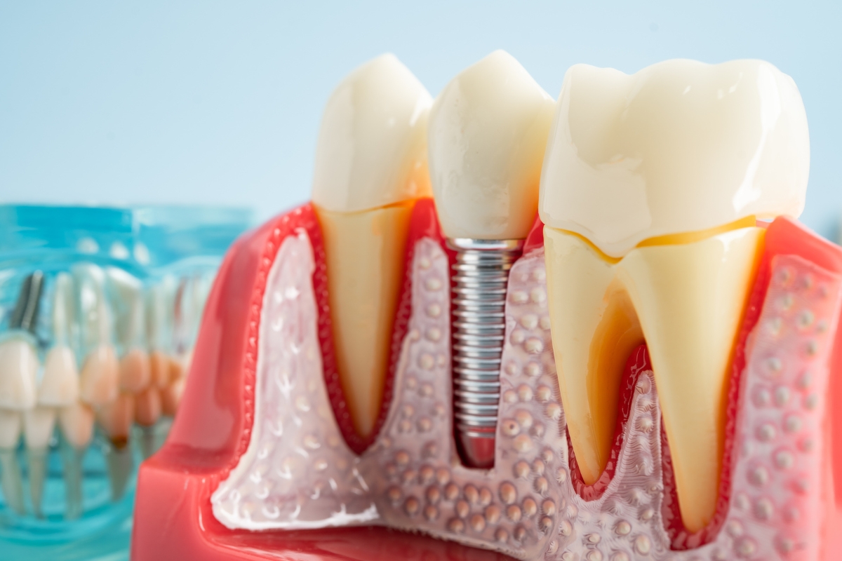 dental-implants-in-Chicago