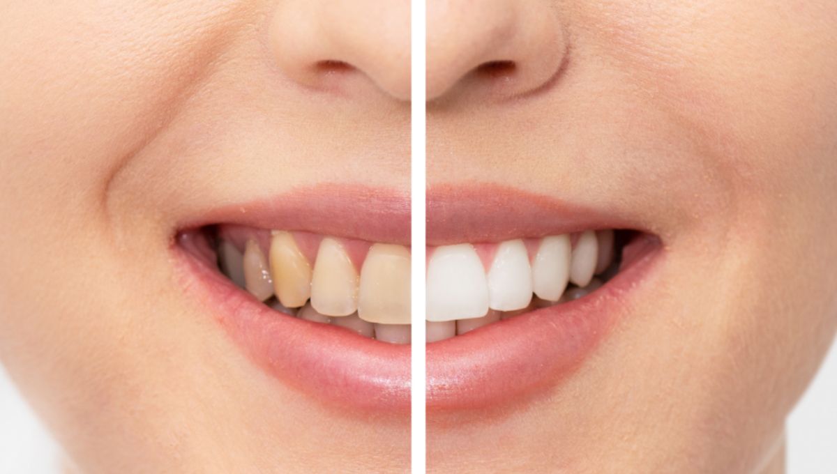 Teeth whitening Chicago